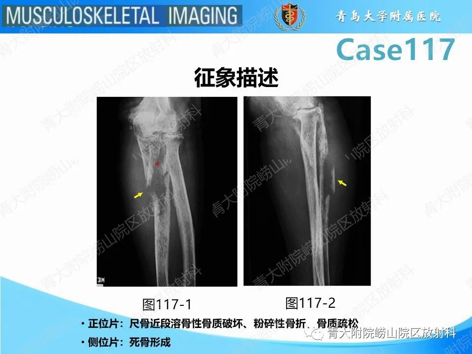 影像PPT - 【PPT】原发性骨淋巴瘤-25