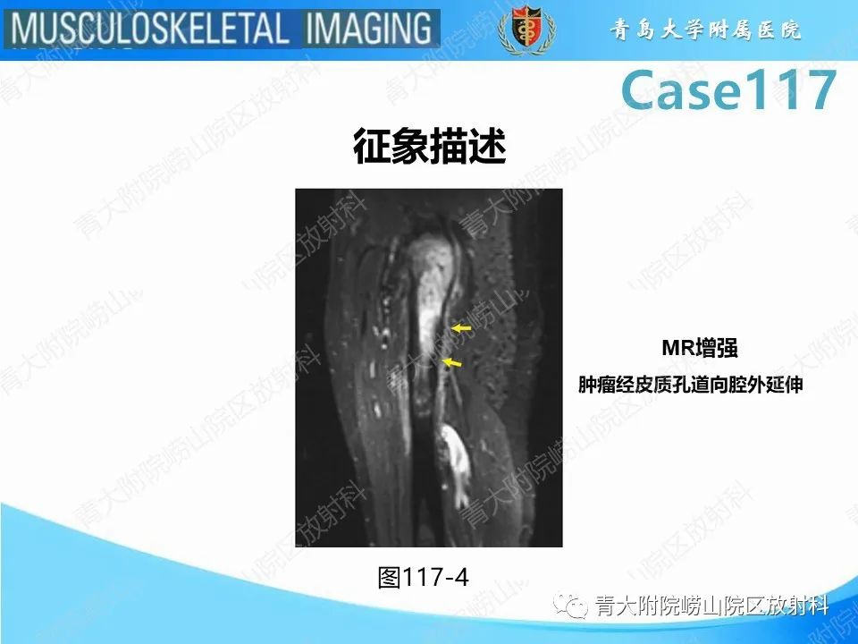 影像PPT - 【PPT】原发性骨淋巴瘤-27