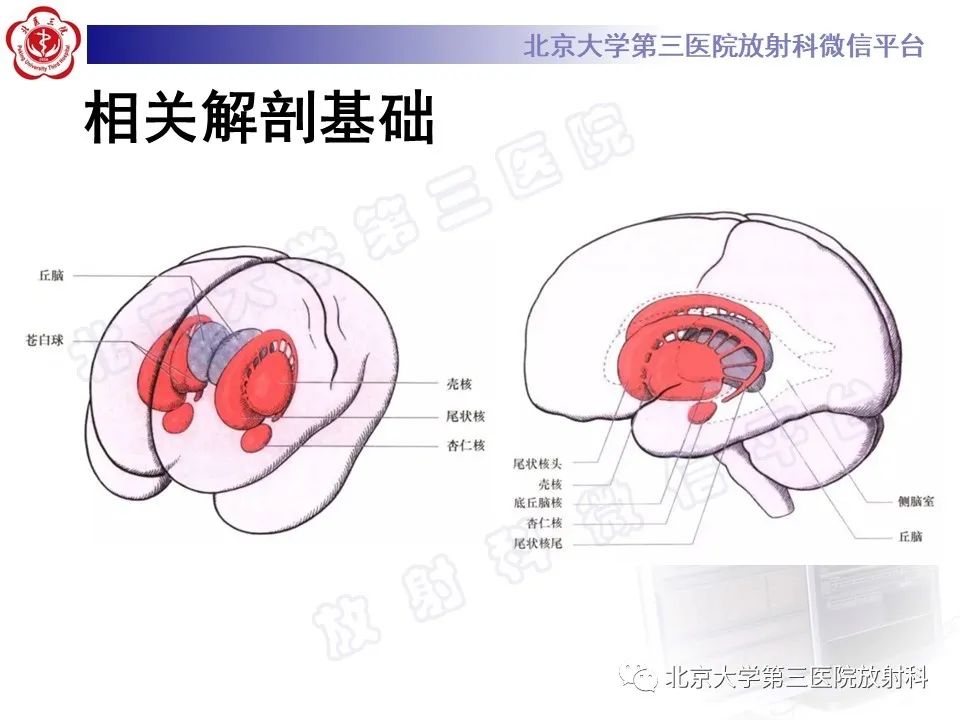 影像PPT - 【PPT】基底节区与丘脑对称性病变-5
