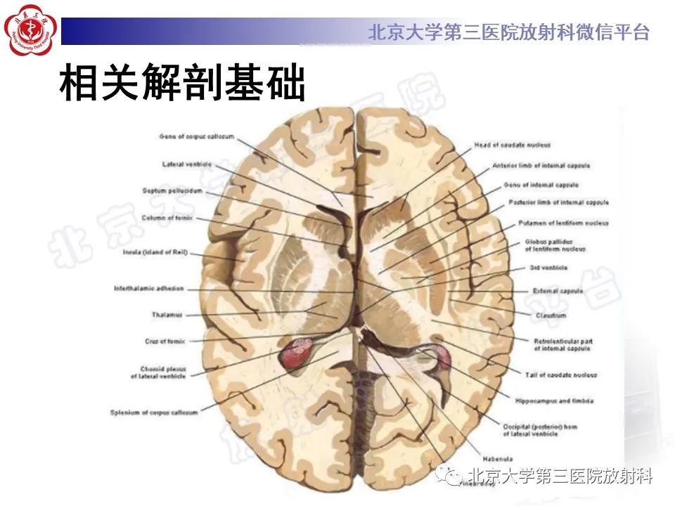 影像PPT - 【PPT】基底节区与丘脑对称性病变-6