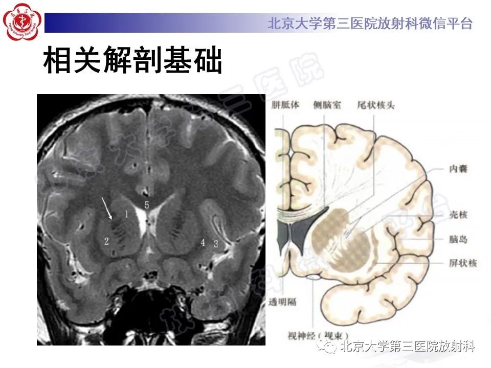 影像PPT - 【PPT】基底节区与丘脑对称性病变-9