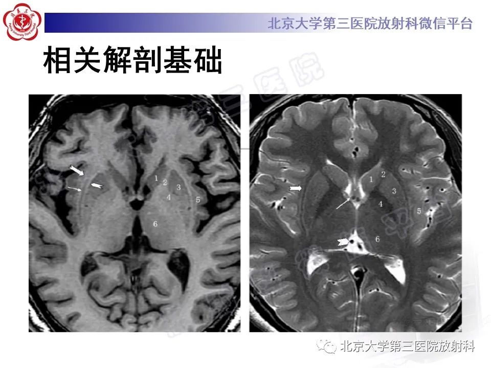 影像PPT - 【PPT】基底节区与丘脑对称性病变-7