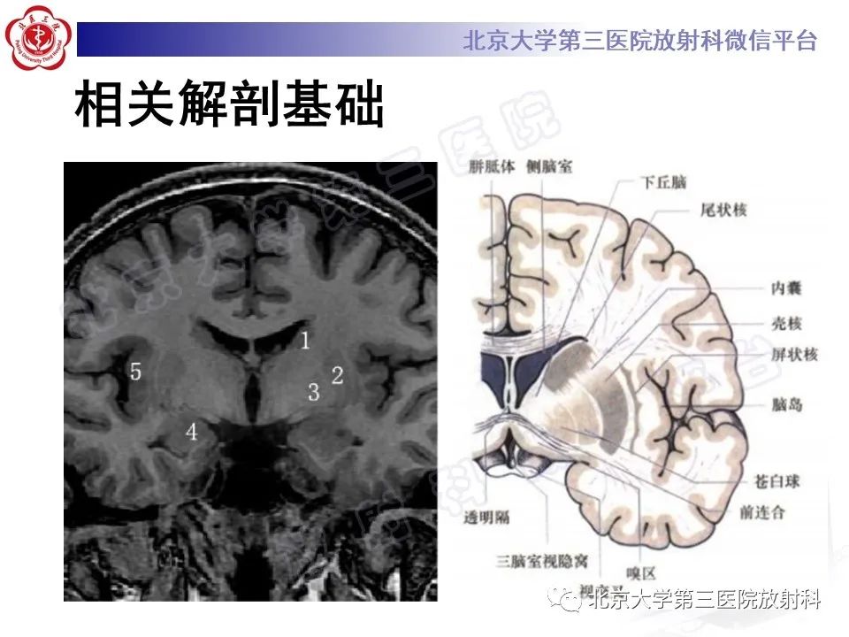 影像PPT - 【PPT】基底节区与丘脑对称性病变-8