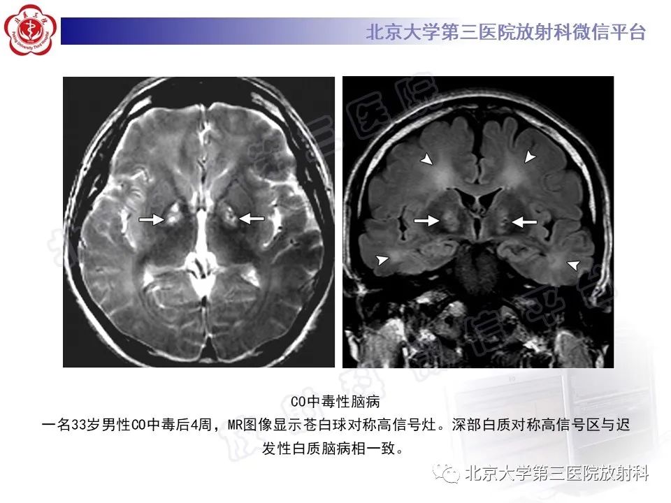 影像PPT - 【PPT】基底节区与丘脑对称性病变-13