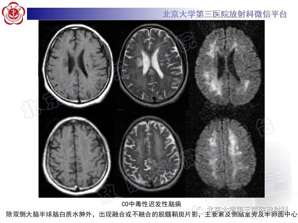 影像PPT - 【PPT】基底节区与丘脑对称性病变-14