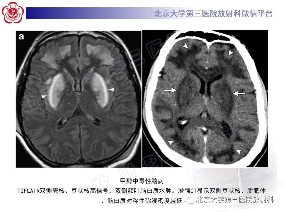 影像PPT - 【PPT】基底节区与丘脑对称性病变-15