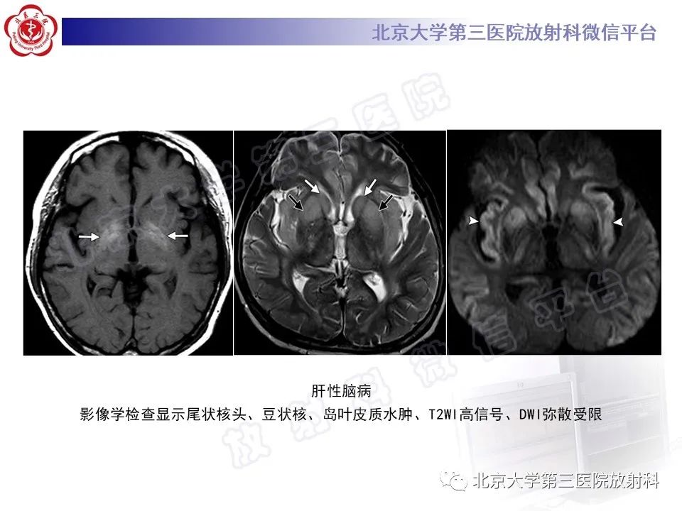 影像PPT - 【PPT】基底节区与丘脑对称性病变-17