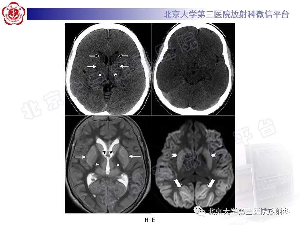 影像PPT - 【PPT】基底节区与丘脑对称性病变-19