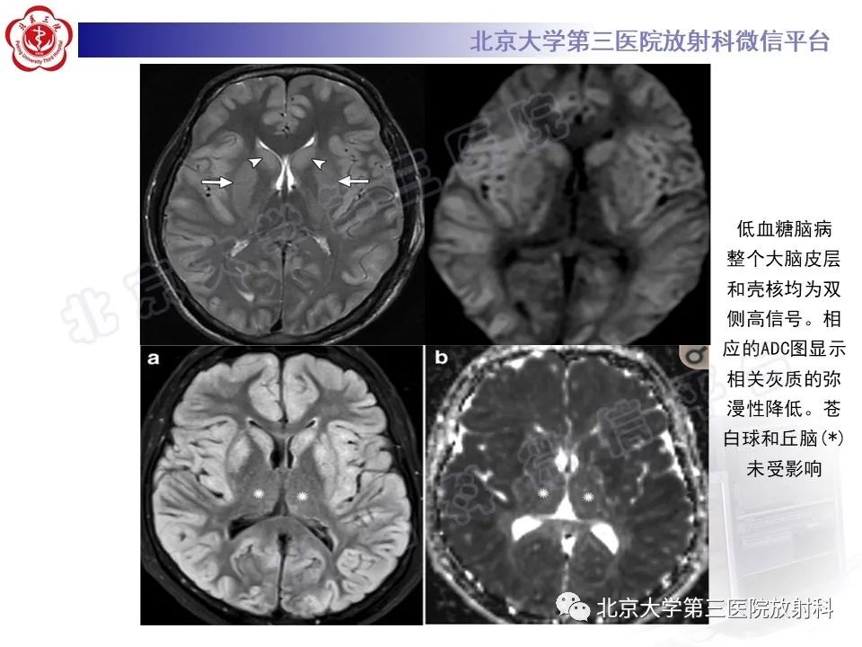 影像PPT - 【PPT】基底节区与丘脑对称性病变-21