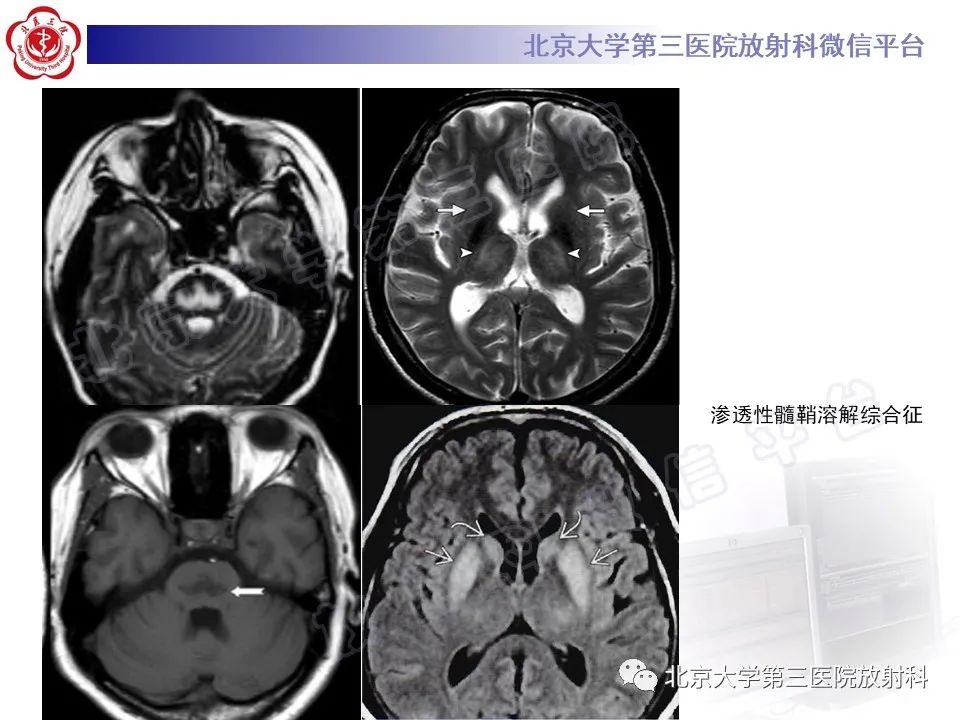 影像PPT - 【PPT】基底节区与丘脑对称性病变-23