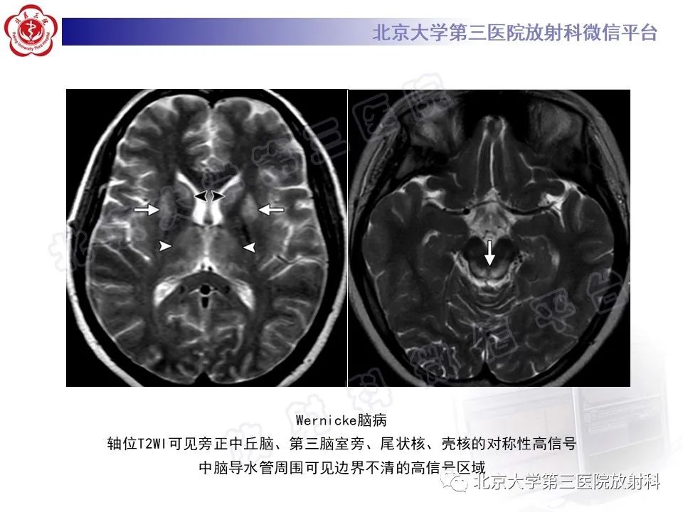 影像PPT - 【PPT】基底节区与丘脑对称性病变-25
