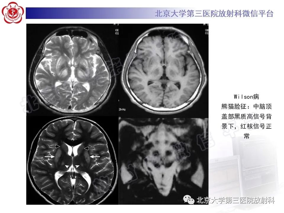 影像PPT - 【PPT】基底节区与丘脑对称性病变-27