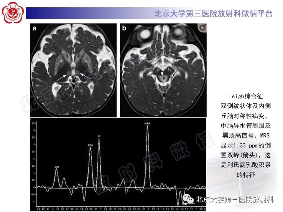 影像PPT - 【PPT】基底节区与丘脑对称性病变-29
