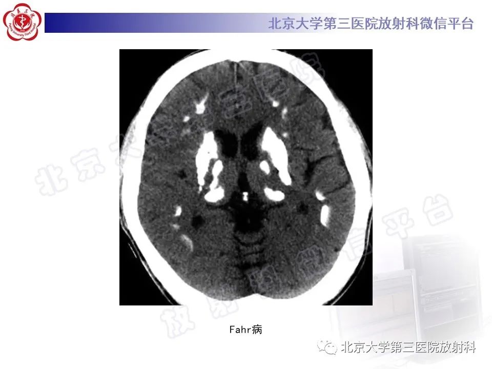影像PPT - 【PPT】基底节区与丘脑对称性病变-31