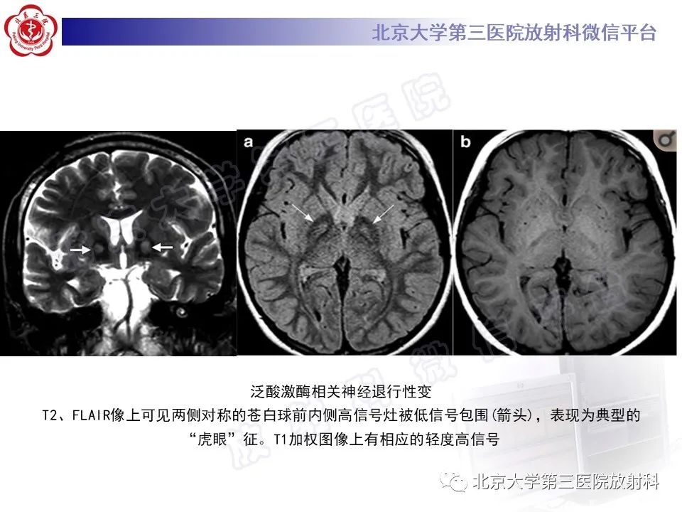 影像PPT - 【PPT】基底节区与丘脑对称性病变-33