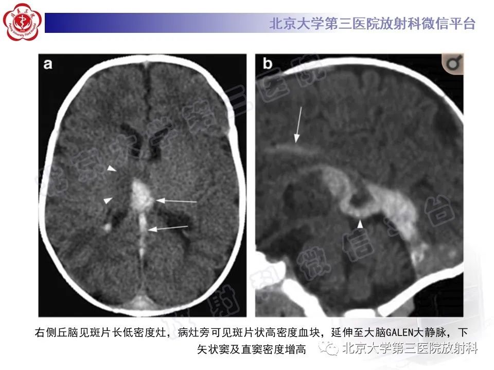 影像PPT - 【PPT】基底节区与丘脑对称性病变-36