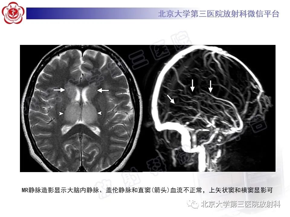 影像PPT - 【PPT】基底节区与丘脑对称性病变-35
