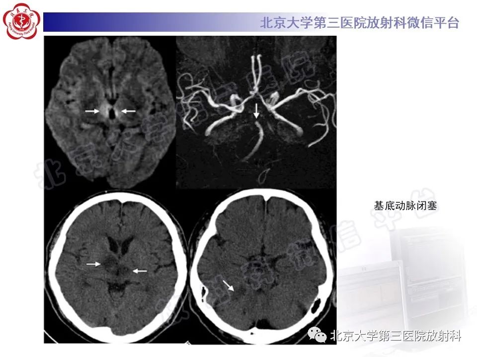 影像PPT - 【PPT】基底节区与丘脑对称性病变-38