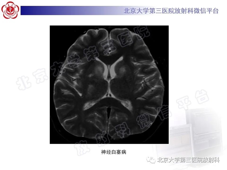 影像PPT - 【PPT】基底节区与丘脑对称性病变-42