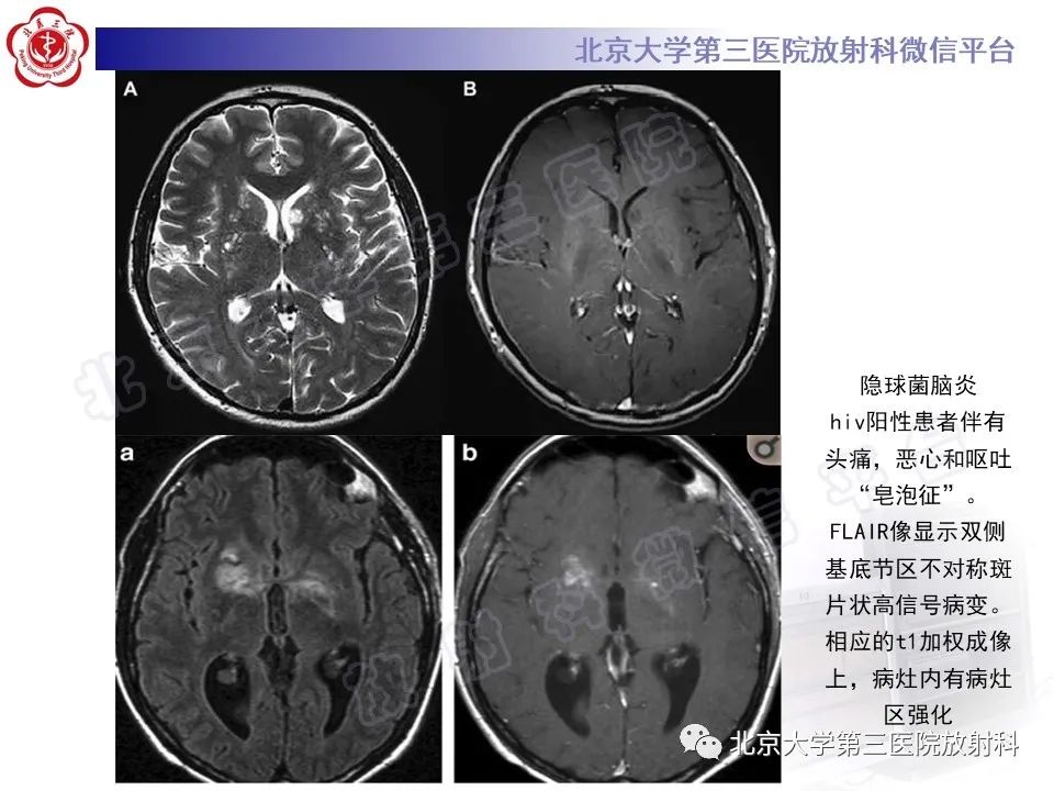 影像PPT - 【PPT】基底节区与丘脑对称性病变-40
