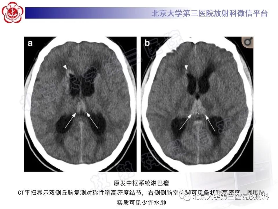 影像PPT - 【PPT】基底节区与丘脑对称性病变-44
