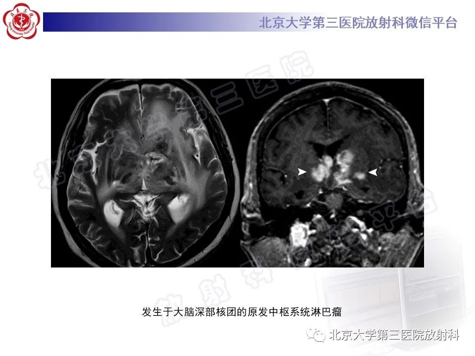影像PPT - 【PPT】基底节区与丘脑对称性病变-45