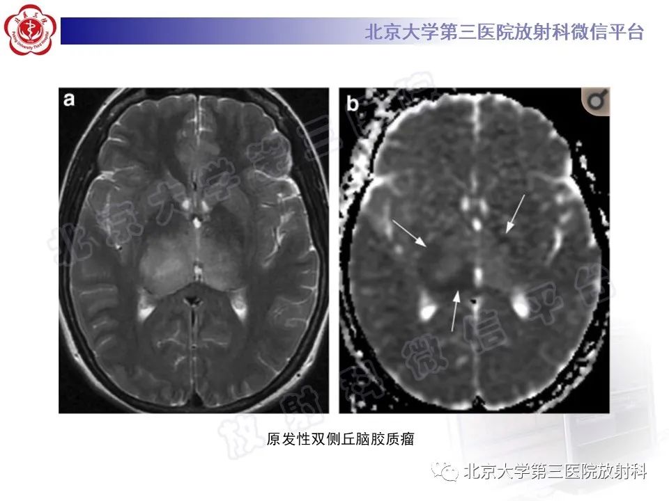 影像PPT - 【PPT】基底节区与丘脑对称性病变-48