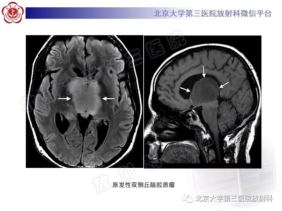 影像PPT - 【PPT】基底节区与丘脑对称性病变-47