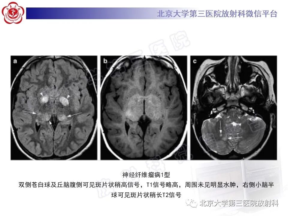 影像PPT - 【PPT】基底节区与丘脑对称性病变-50