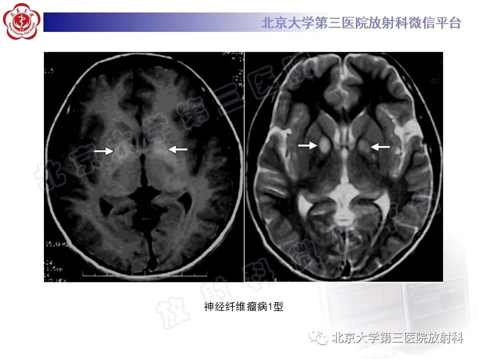 影像PPT - 【PPT】基底节区与丘脑对称性病变-51