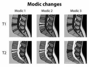 影像PPT - 椎体终板炎发生机制、分型以及 MRI 表现-3 影像PPT - 椎体终板炎发生机制、分型以及 MRI 表现-3