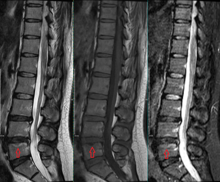 影像PPT - 椎体终板炎发生机制、分型以及 MRI 表现-4 影像PPT - 椎体终板炎发生机制、分型以及 MRI 表现-4