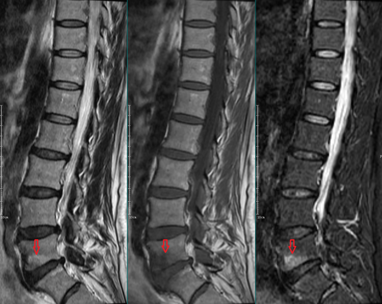 影像PPT - 椎体终板炎发生机制、分型以及 MRI 表现-5 影像PPT - 椎体终板炎发生机制、分型以及 MRI 表现-5