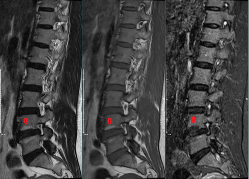 影像PPT - 椎体终板炎发生机制、分型以及 MRI 表现-6 影像PPT - 椎体终板炎发生机制、分型以及 MRI 表现-6