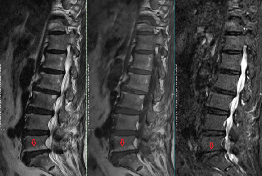 影像PPT - 椎体终板炎发生机制、分型以及 MRI 表现-7 影像PPT - 椎体终板炎发生机制、分型以及 MRI 表现-7
