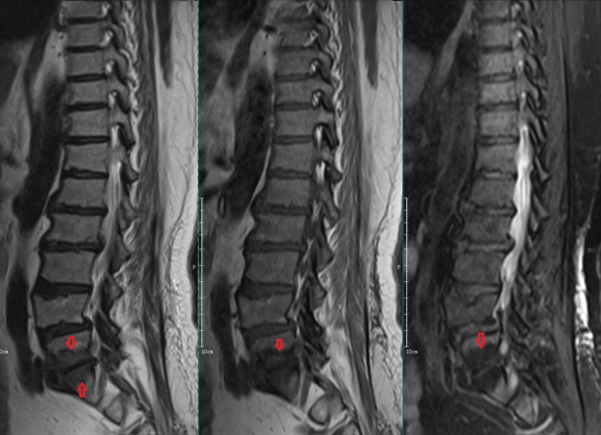 影像PPT - 椎体终板炎发生机制、分型以及 MRI 表现-8 影像PPT - 椎体终板炎发生机制、分型以及 MRI 表现-8
