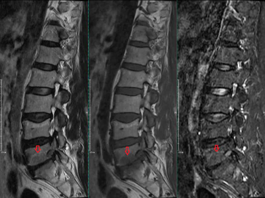 影像PPT - 椎体终板炎发生机制、分型以及 MRI 表现-9 影像PPT - 椎体终板炎发生机制、分型以及 MRI 表现-9