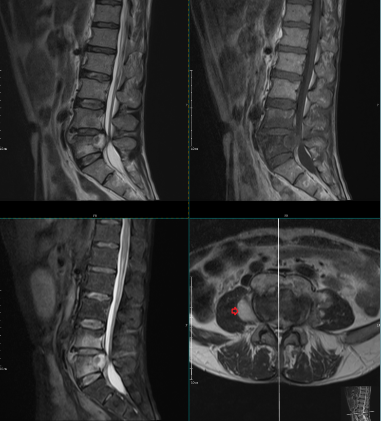影像PPT - 椎体终板炎发生机制、分型以及 MRI 表现-10 影像PPT - 椎体终板炎发生机制、分型以及 MRI 表现-10