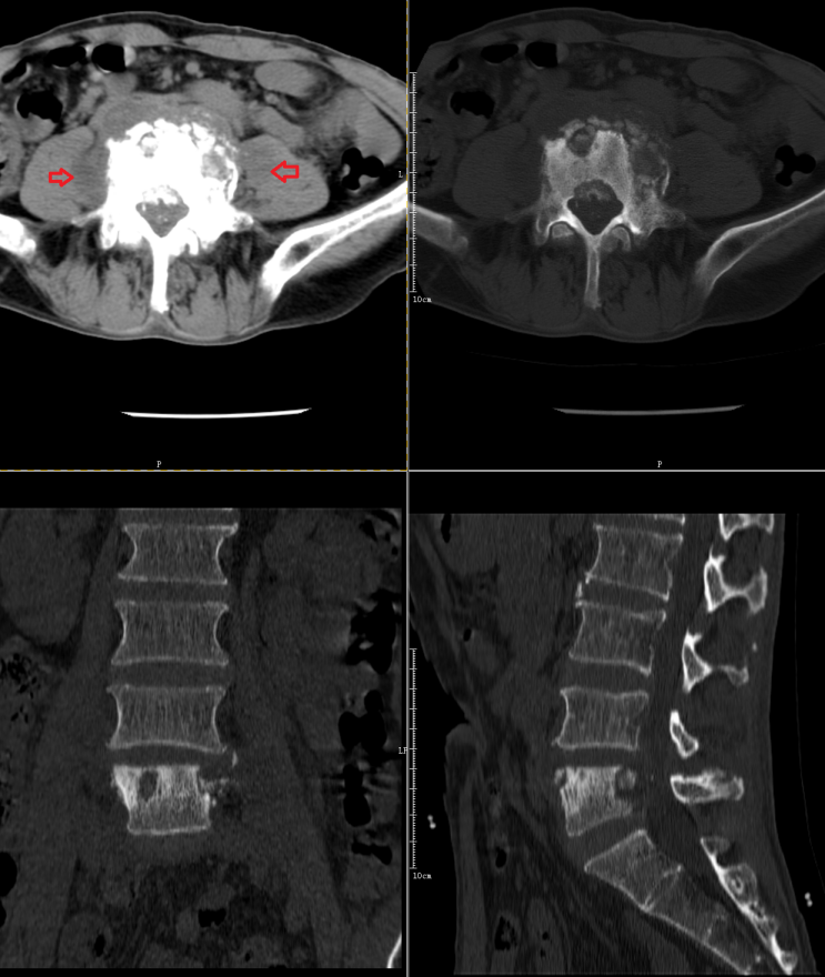 影像PPT - 椎体终板炎发生机制、分型以及 MRI 表现-11 影像PPT - 椎体终板炎发生机制、分型以及 MRI 表现-11
