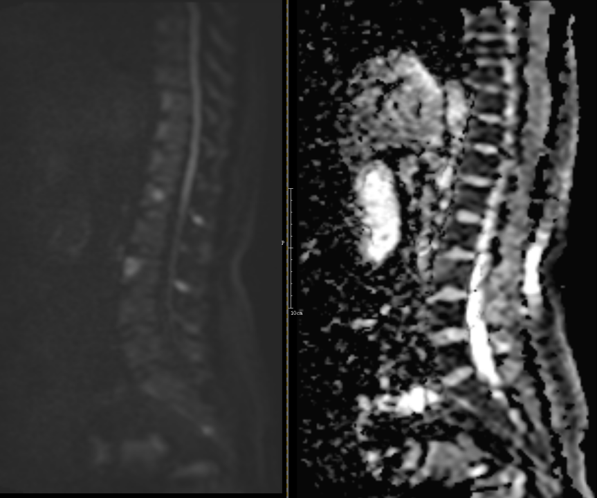 影像PPT - 椎体终板炎发生机制、分型以及 MRI 表现-13 影像PPT - 椎体终板炎发生机制、分型以及 MRI 表现-13