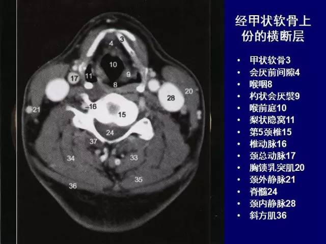 影像PPT - 【PPT】颈部和喉的断层解剖-23