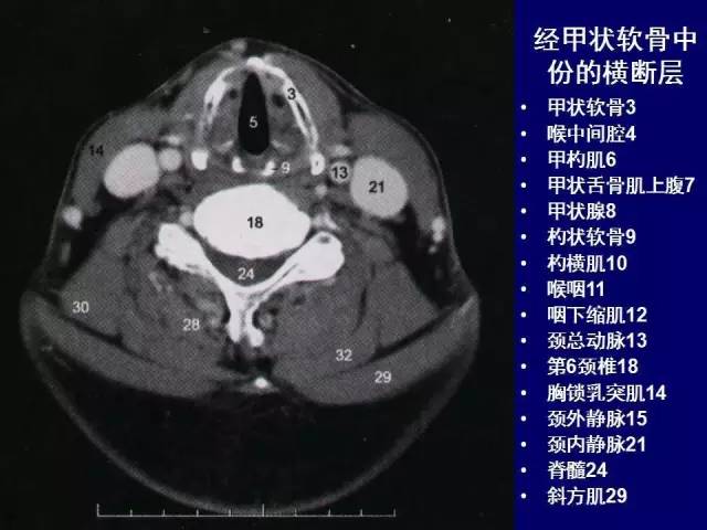 影像PPT - 【PPT】颈部和喉的断层解剖-24