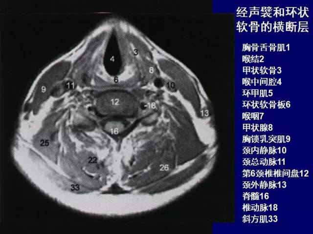 影像PPT - 【PPT】颈部和喉的断层解剖-25