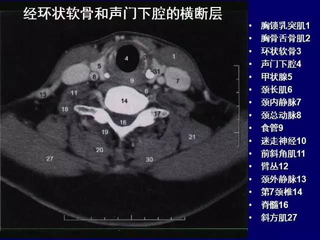 影像PPT - 【PPT】颈部和喉的断层解剖-26