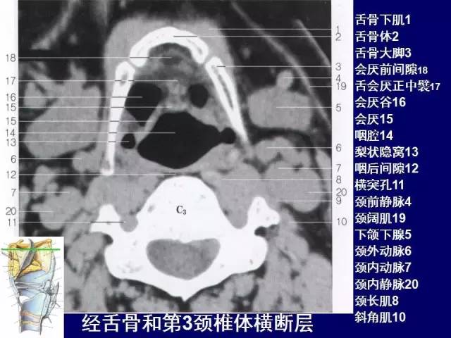 影像PPT - 【PPT】颈部和喉的断层解剖-47