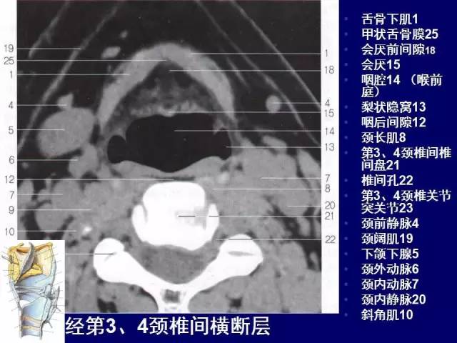 影像PPT - 【PPT】颈部和喉的断层解剖-48