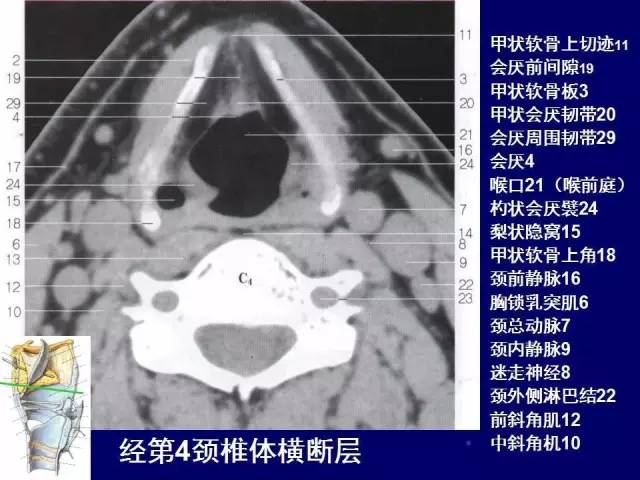 影像PPT - 【PPT】颈部和喉的断层解剖-49