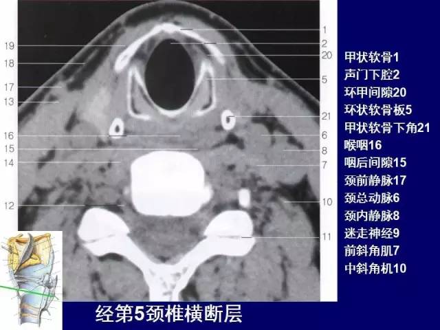 影像PPT - 【PPT】颈部和喉的断层解剖-53