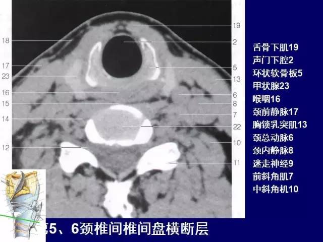 影像PPT - 【PPT】颈部和喉的断层解剖-54