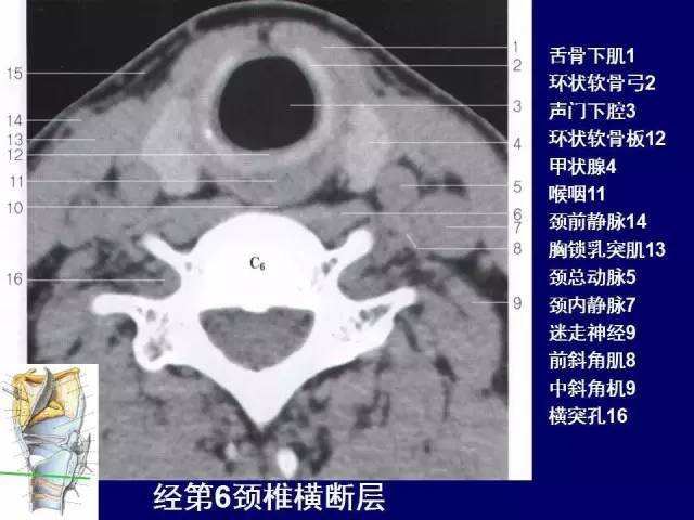 影像PPT - 【PPT】颈部和喉的断层解剖-55